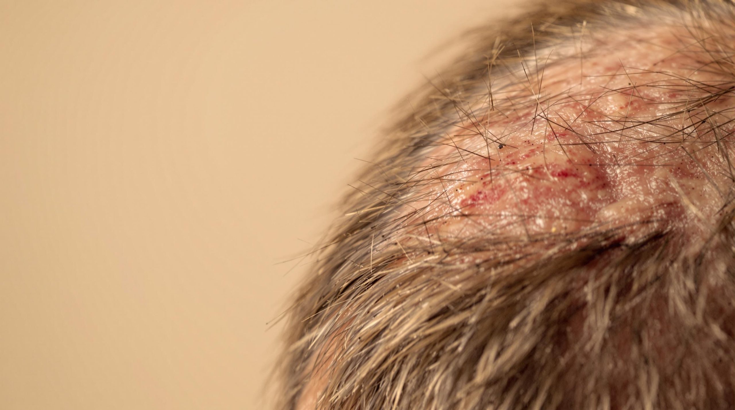 Cuir chevelu rouge qui gratte : causes, traitements et quand consulter - Eclat Cosmetique